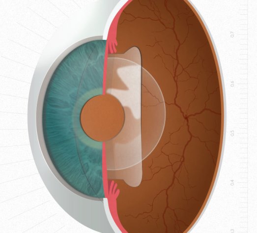 ICL Nuevas lentes intraoculares para corregir la miopía